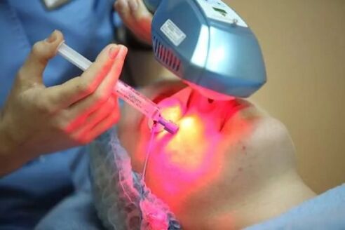 Biorivitalizzazione laser della pelle del viso