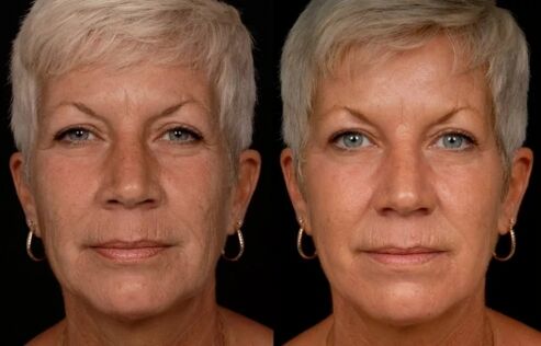 Il risultato del trattamento laser della pelle del viso - riduzione delle rughe