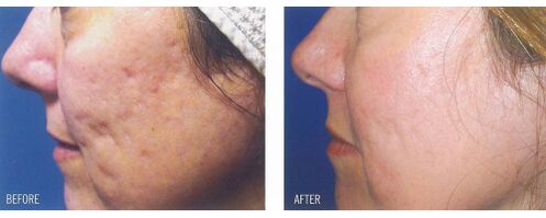 Prima e dopo l'applicazione del dispositivo laser sulla pelle con cicatrici