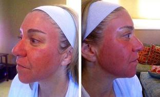 Rossore del viso dopo il ringiovanimento laser