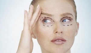 tipi di blefaroplastica per ringiovanire la pelle intorno agli occhi