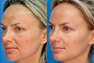 foto prima e dopo il ringiovanimento della pelle con il dispositivo